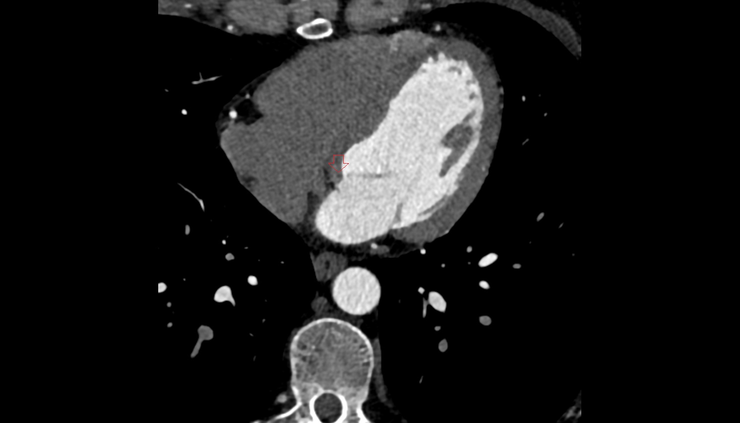 Atrioventricular node (AV node) anatomy  CT axial   image -img-00000-00000