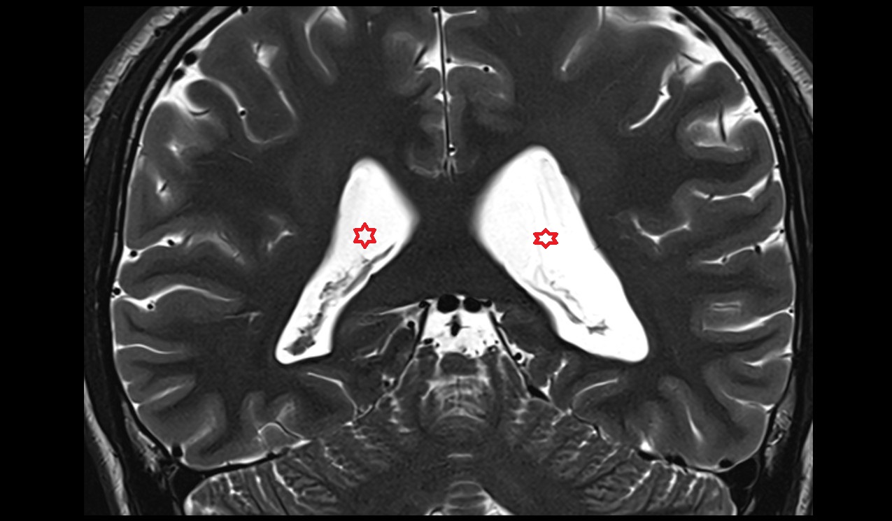 Atrium - Lateral ventricle mri 3t coronal image