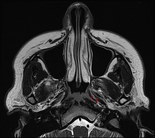 Auditory tube mri axial image -img-00000-00000_00001