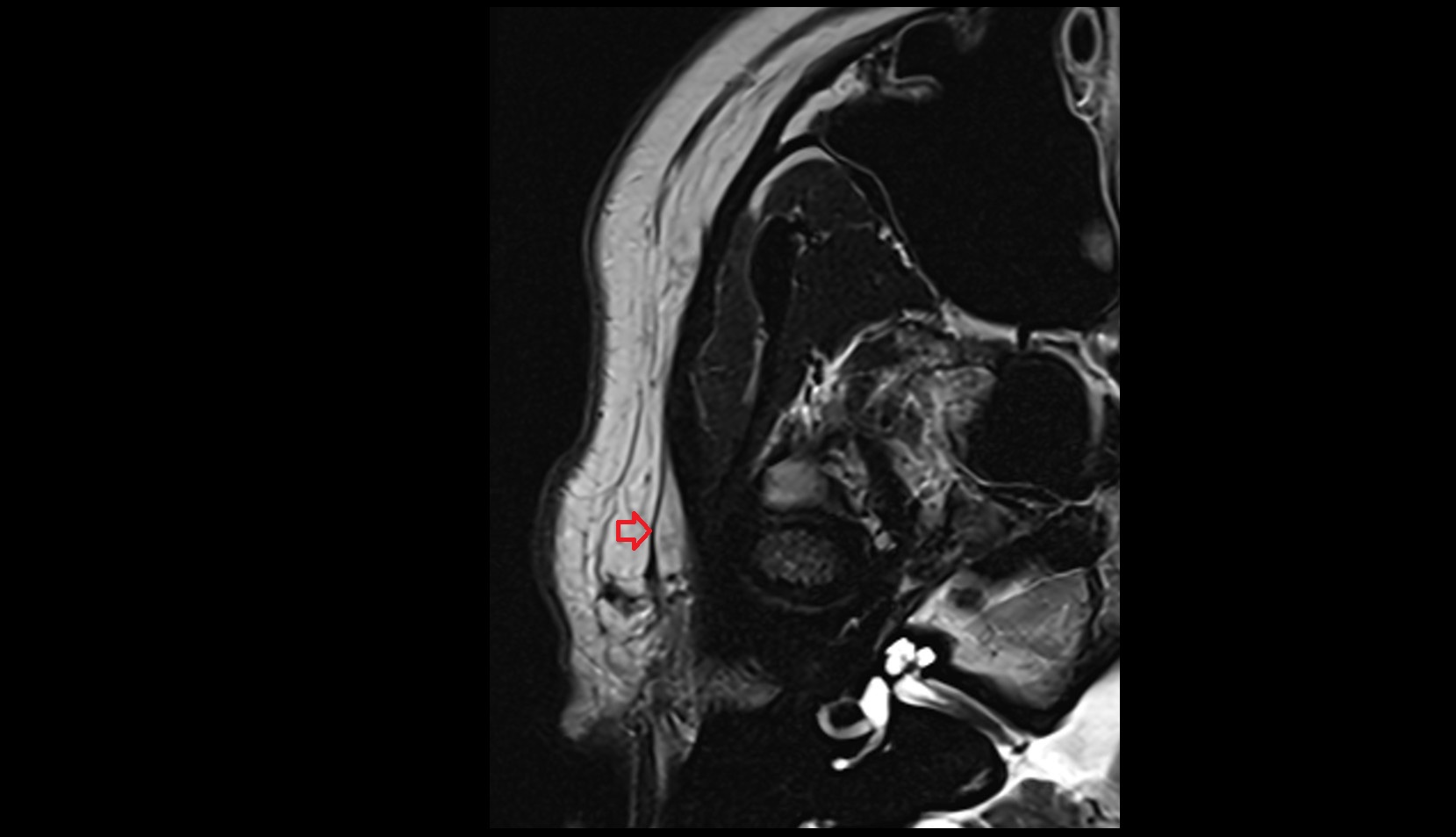 Auricularis anterior muscle axial image