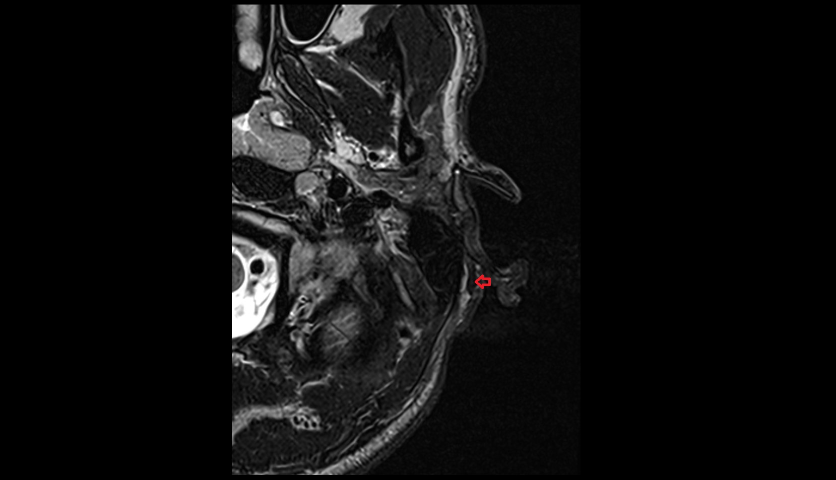 Auricularis posterior muscle axial image