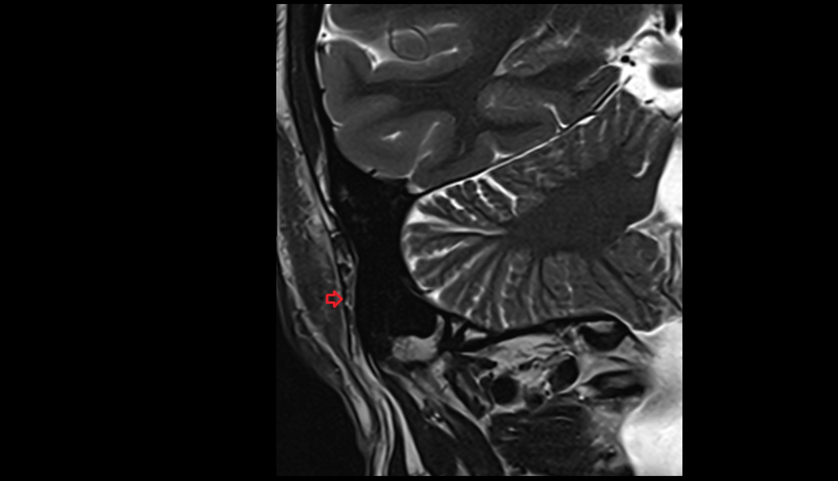 Auricularis posterior muscle coronal image