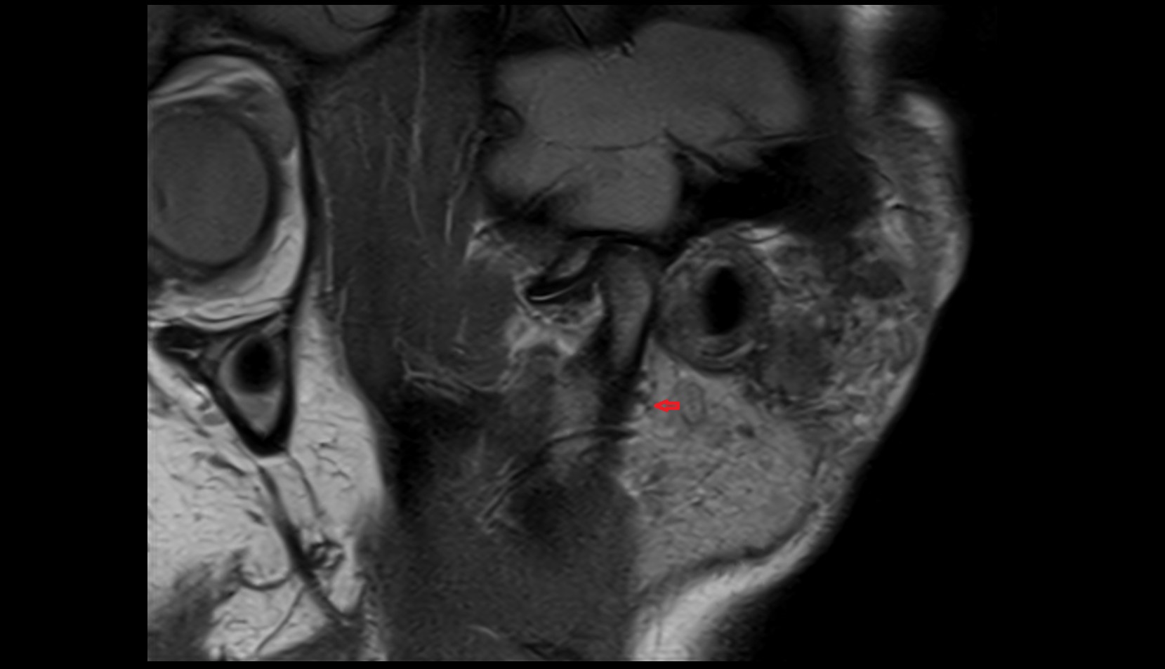 Auriculotemporal nerve mri image