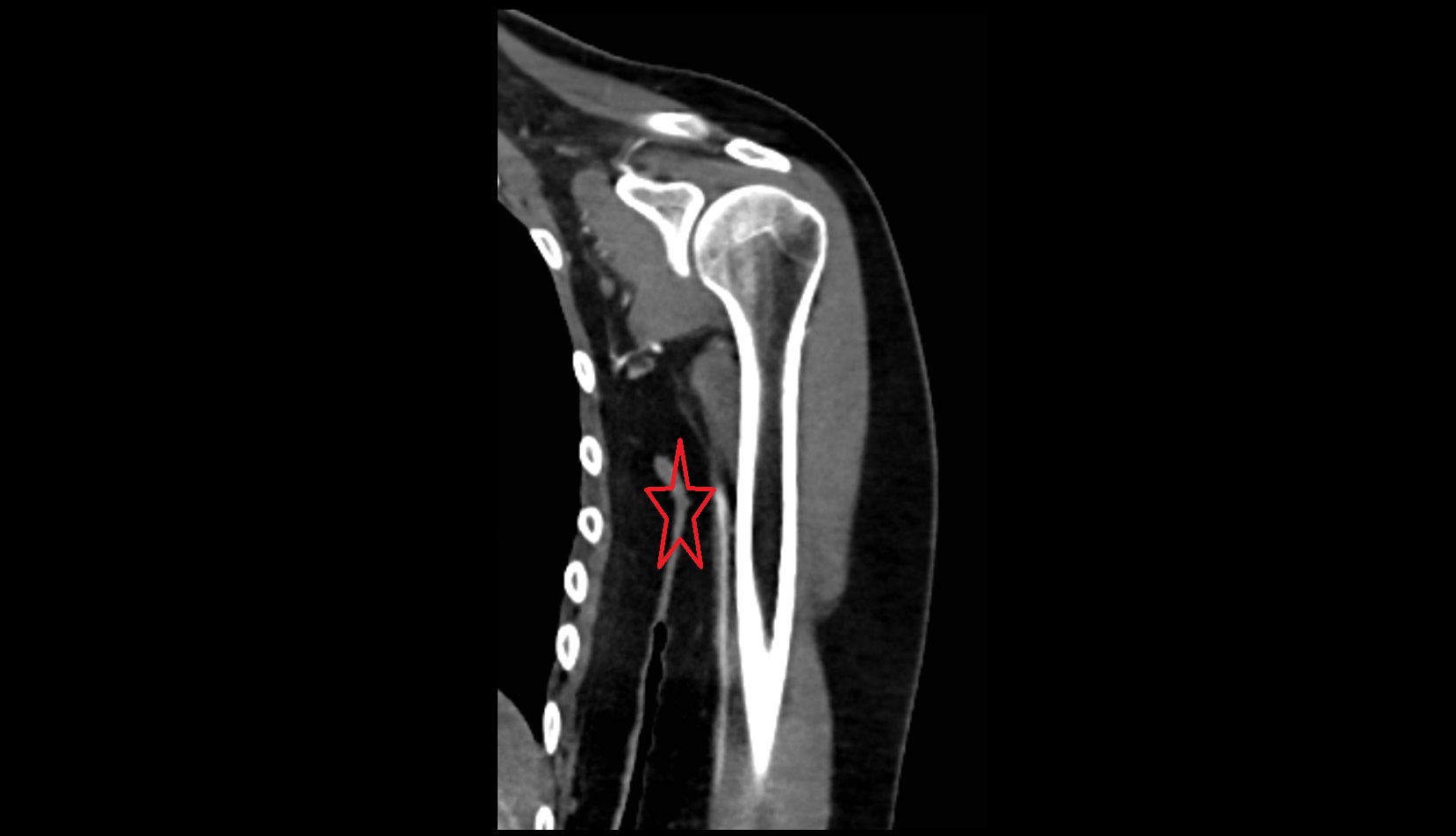 Axilla CT coronal image
