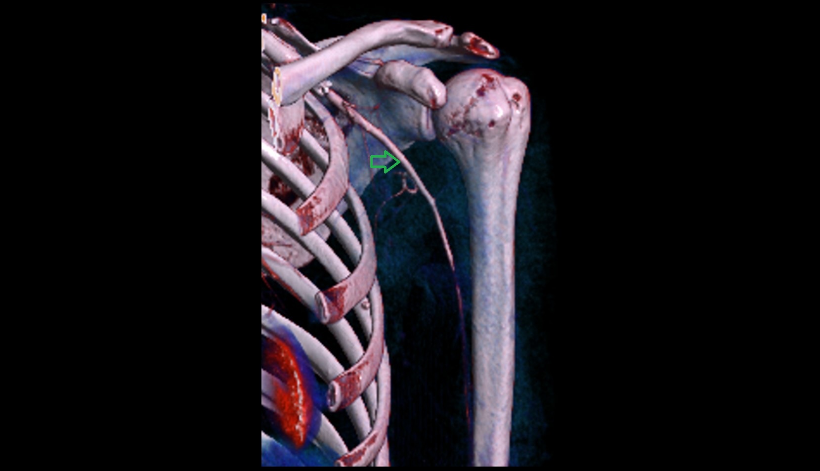 Axillary artery 3d ct image