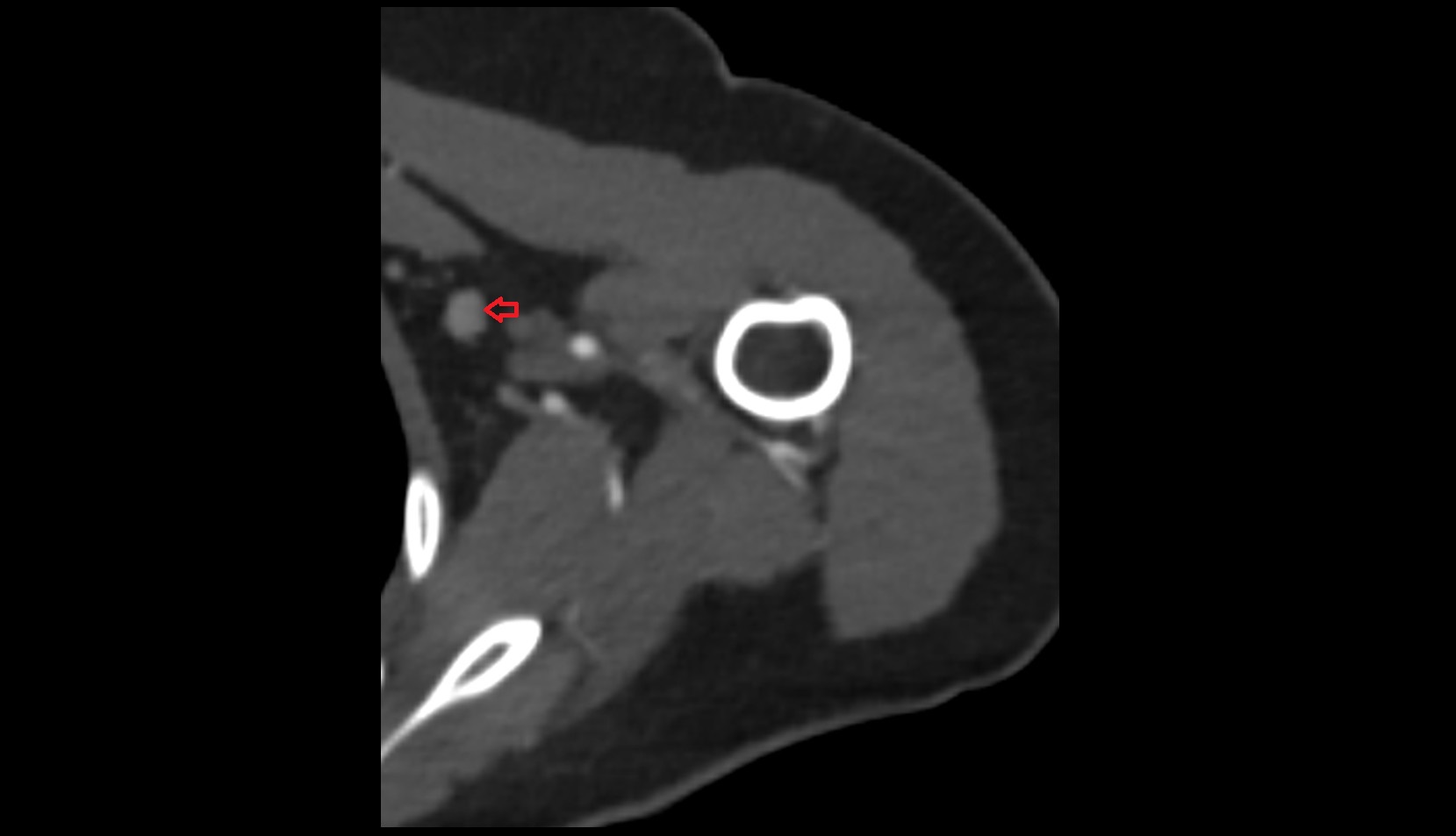 Axillary lymph nodes CT AXIAL SHOULDER IMAGE