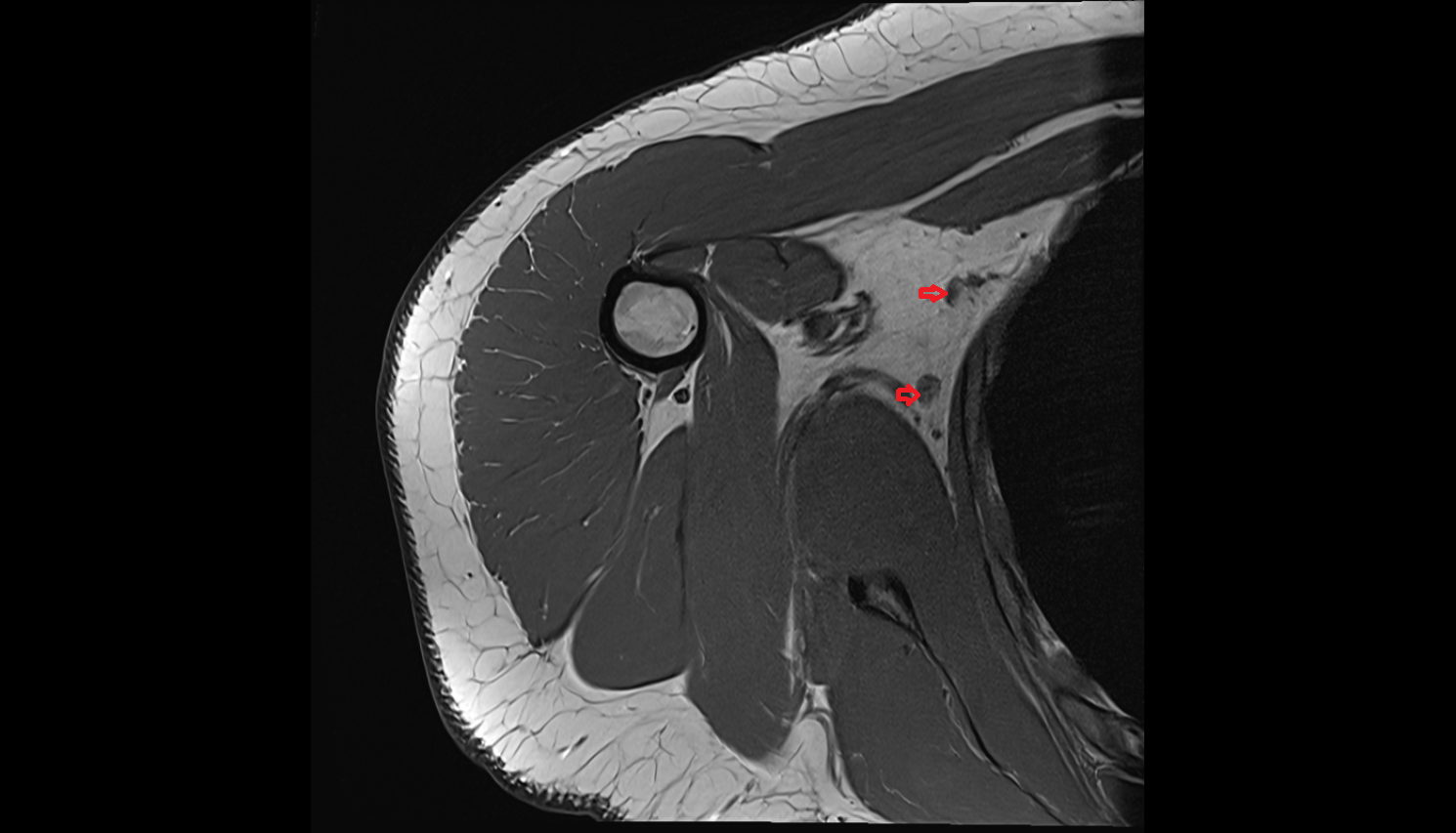 Axillary lymph nodes axial cross sectional anatomy 3T MRI AI enhanced radiology image-img-00000-00000