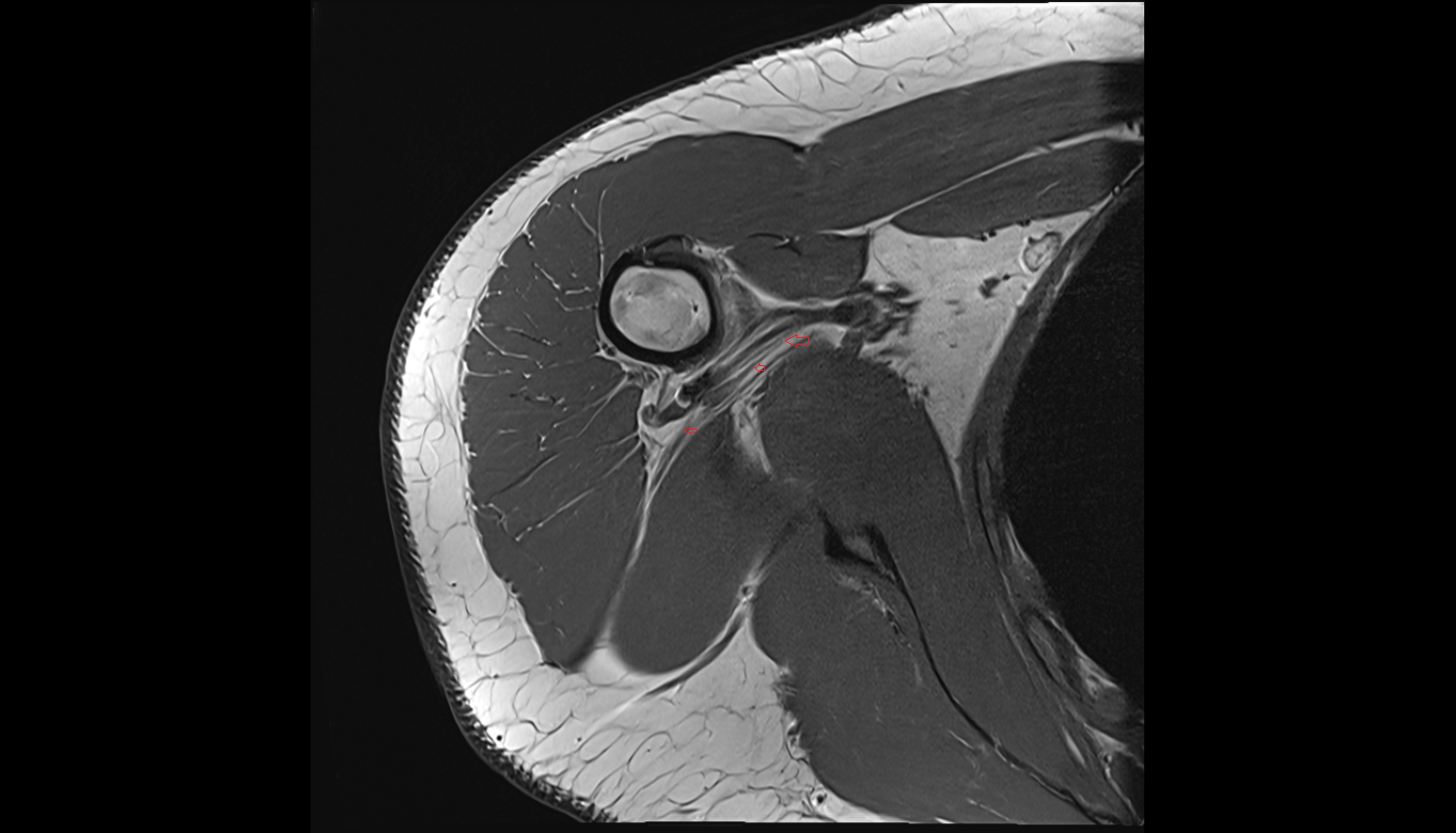 Axillary nerve axial cross sectional anatomy 3T MRI AI enhanced radiology image-img-00000-00000