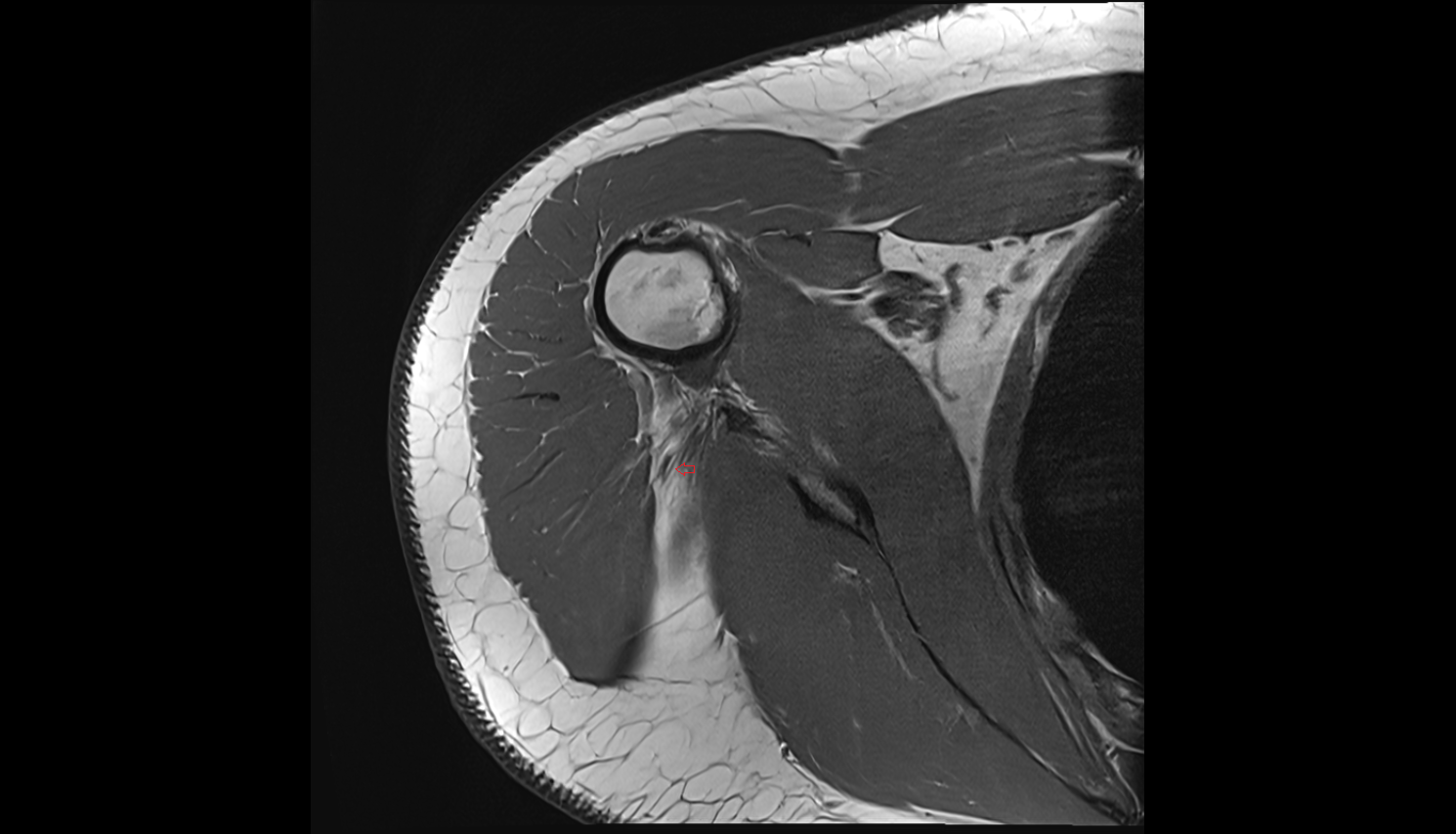 Axillary nerve axial cross sectional anatomy 3T MRI AI enhanced radiology image-img-00000-00000_00001