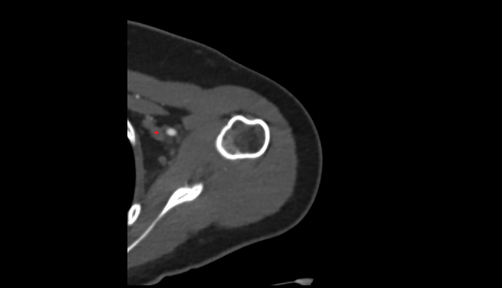 Axillary vein ct axial image