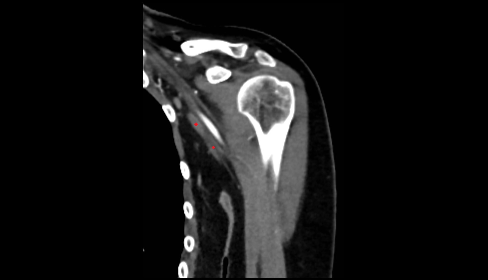 Axillary vein ct coronal