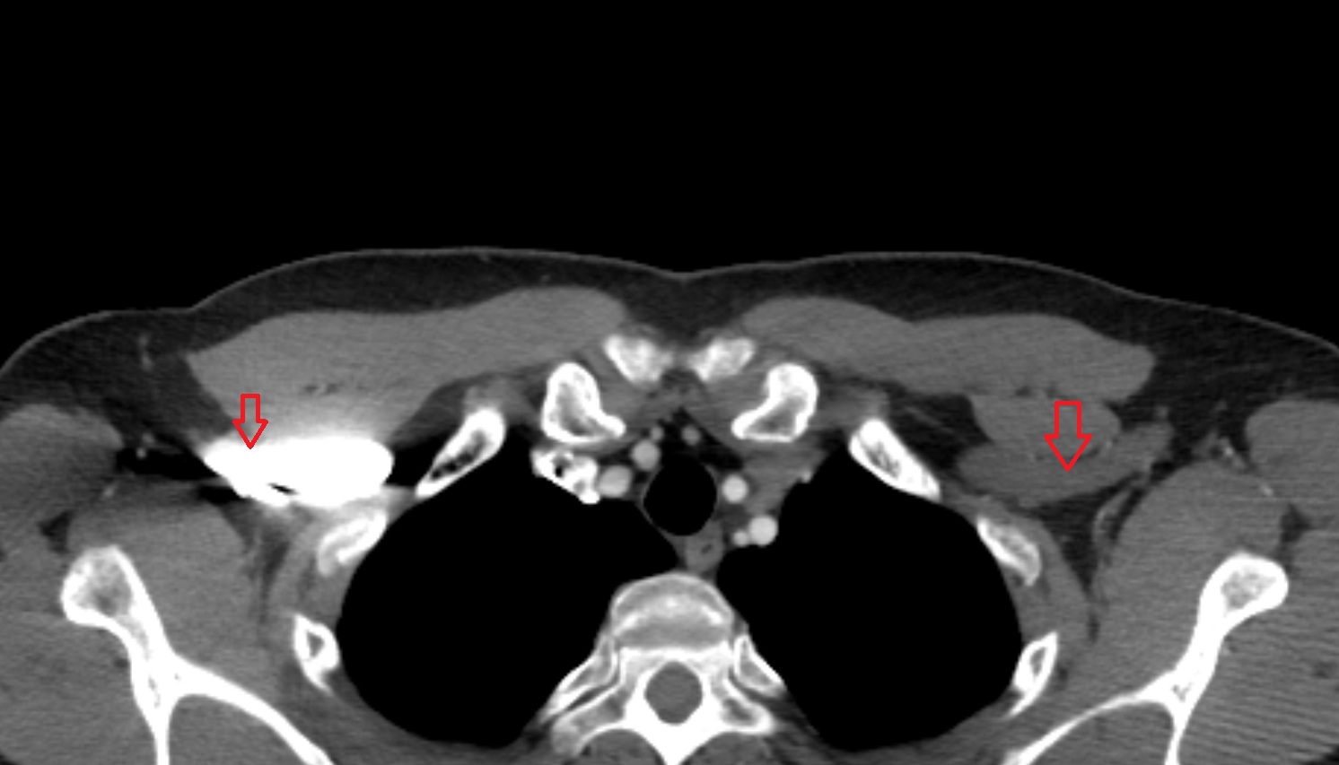 Axillary veins  anatomy axial CT  image -img-00000-00000