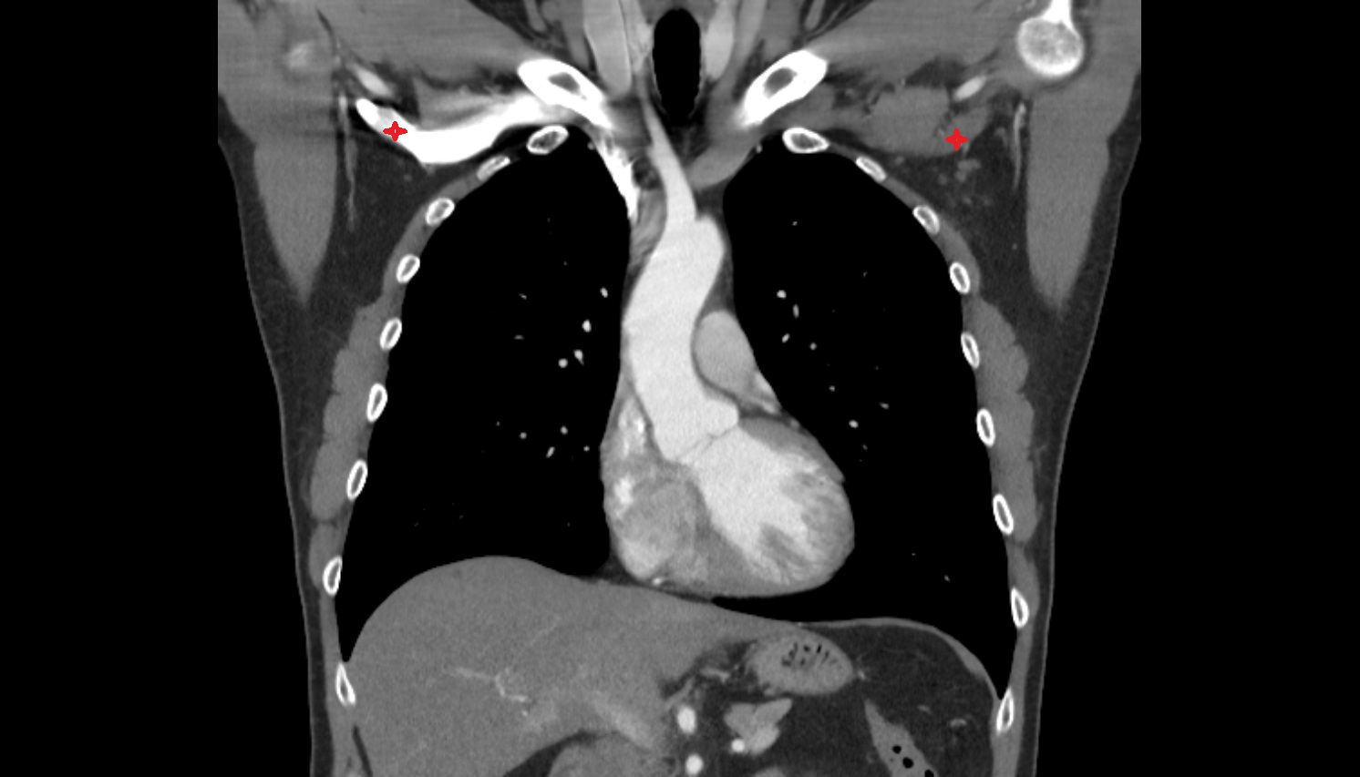 Axillary veins  anatomy coronal CT  image -img-00000-00000
