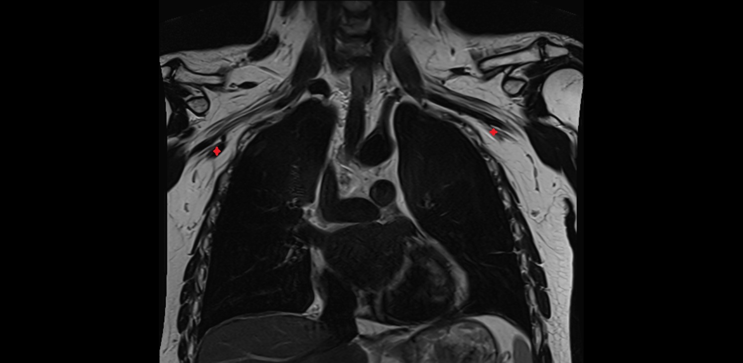 Axillary veins  anatomycoronal mri  image -img-00000-00000