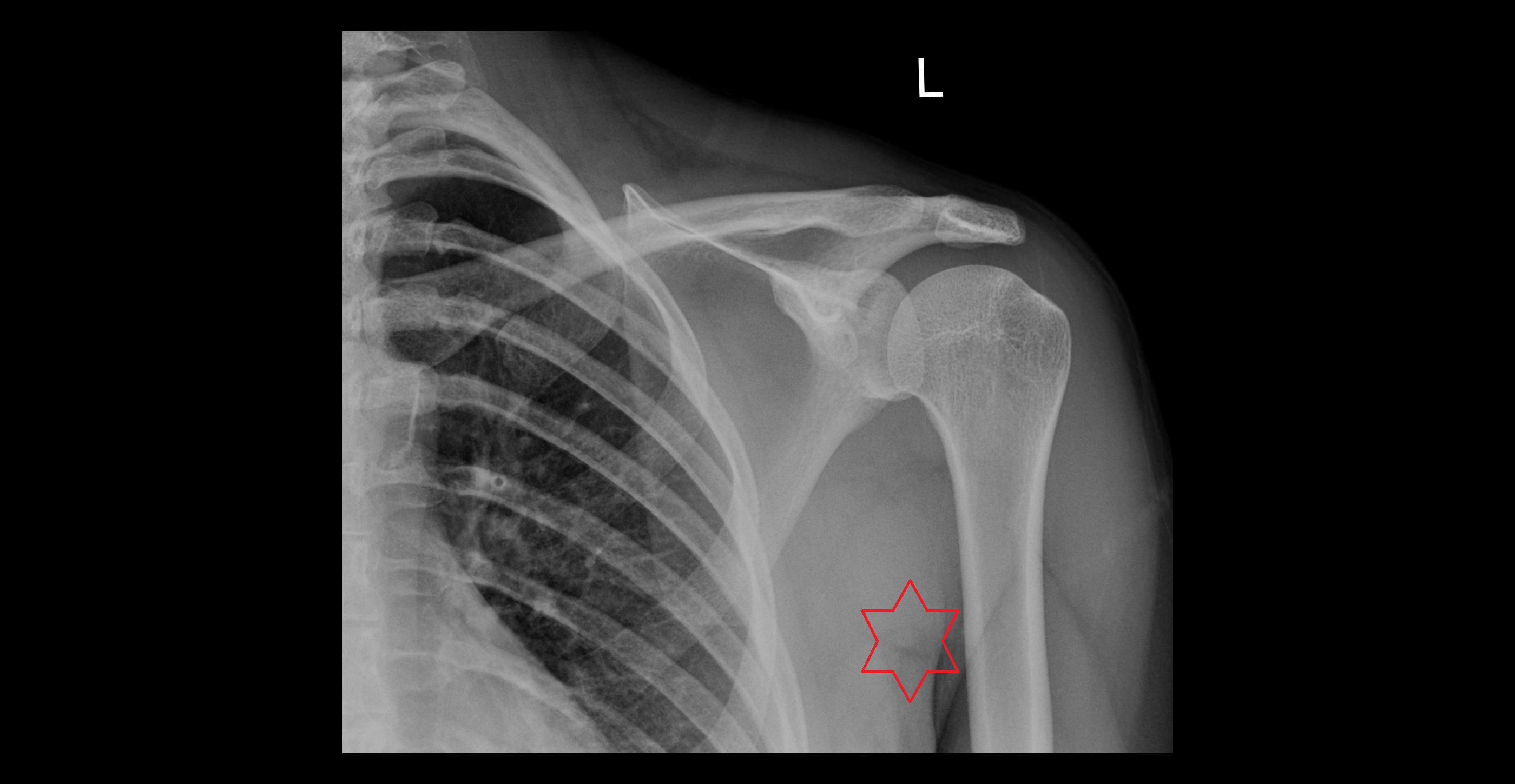 Axilla x ray