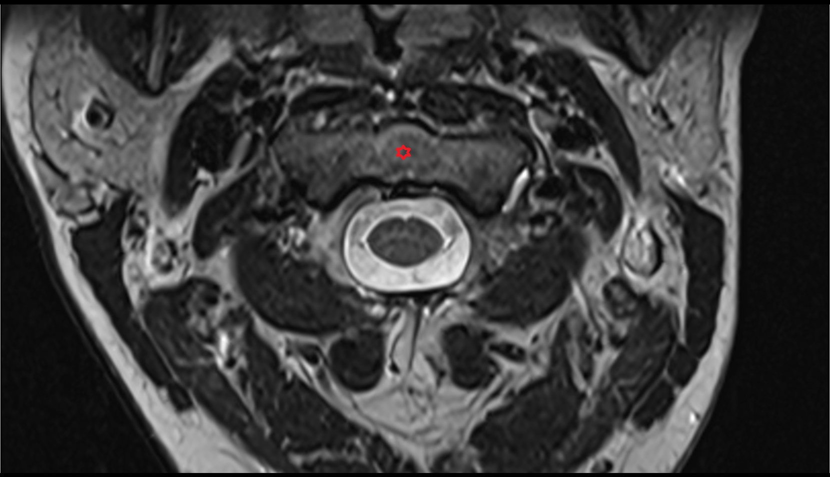 Axis (C2 Vertebra) mri axial image