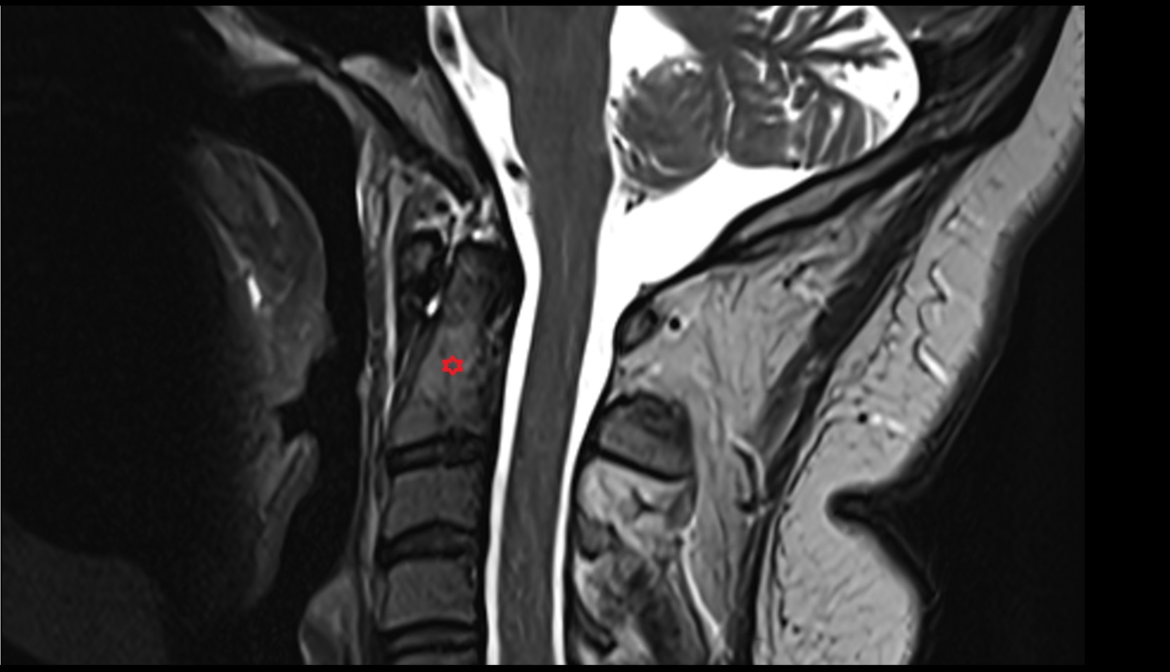 Axis (C2 Vertebra) mri sag  image