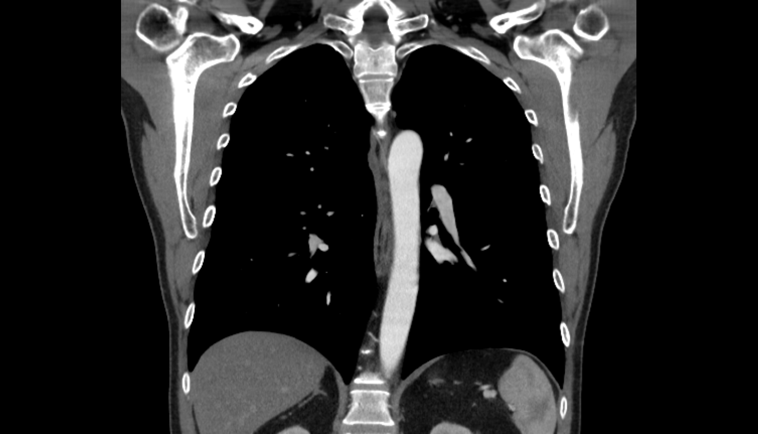 Azygoesophageal line ct  Anatomy, Location and Imaging Appearance CT anatomy image -img-00000-00000