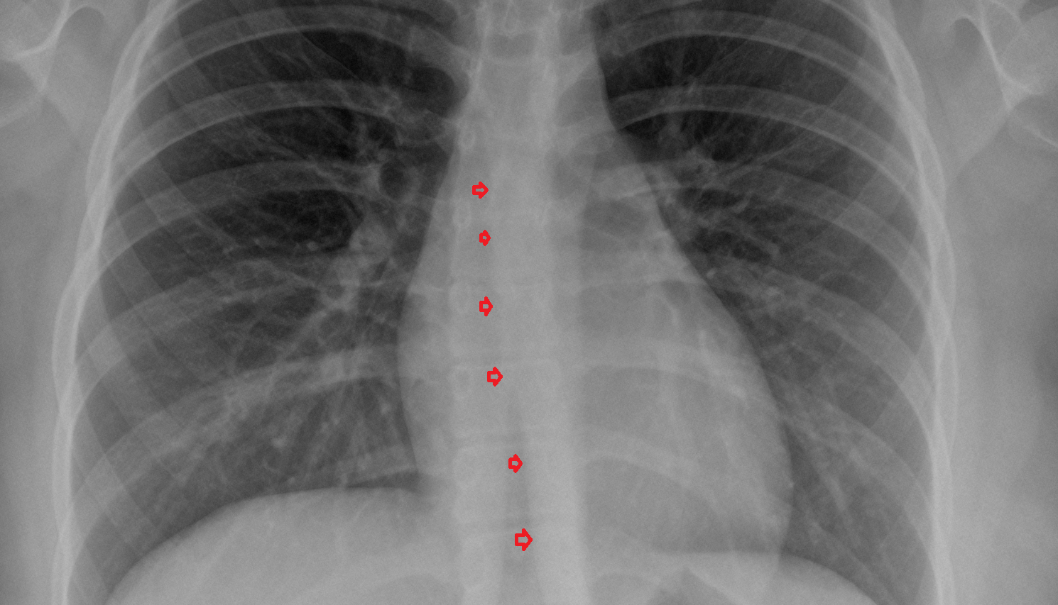 Azygoesophageal line x ray  Anatomy, Location and Imaging Appearance CT anatomy image -img-00000-00000