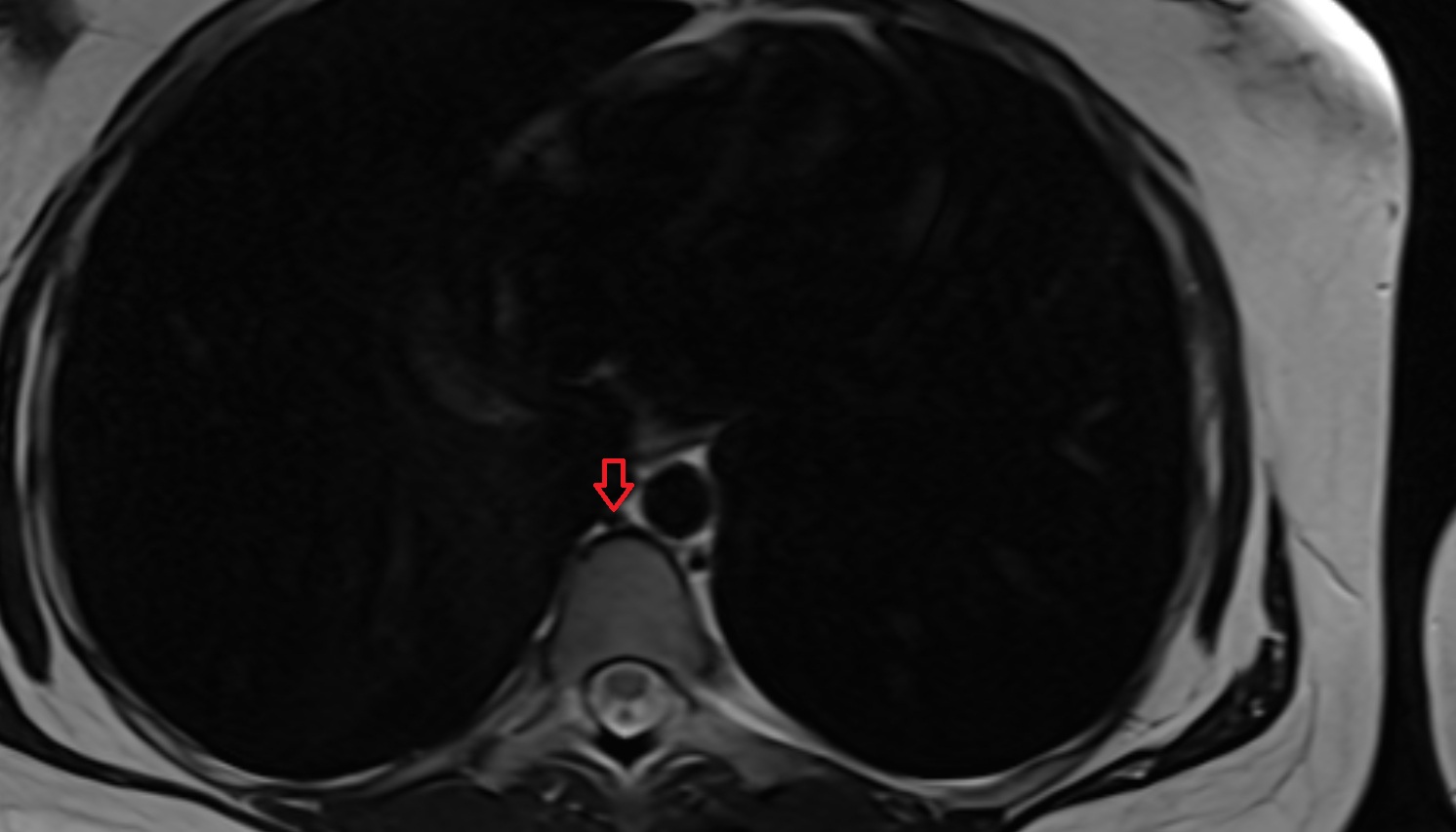 Azygos vein  MRI  axial image -img-00000-00000