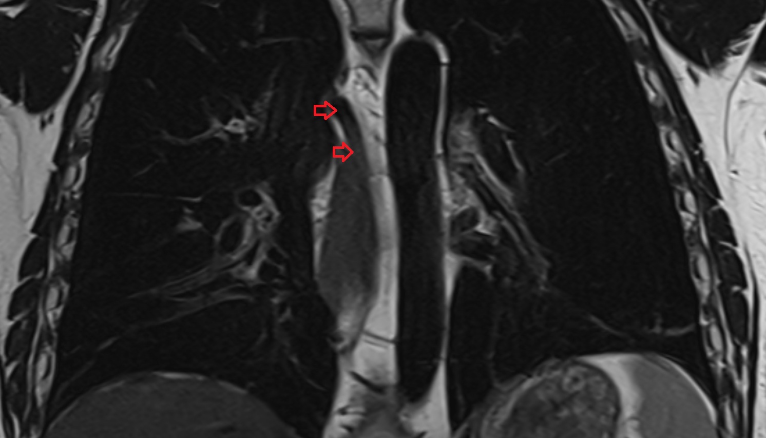 Azygos vein  MRI coronal image -img-00000-00000