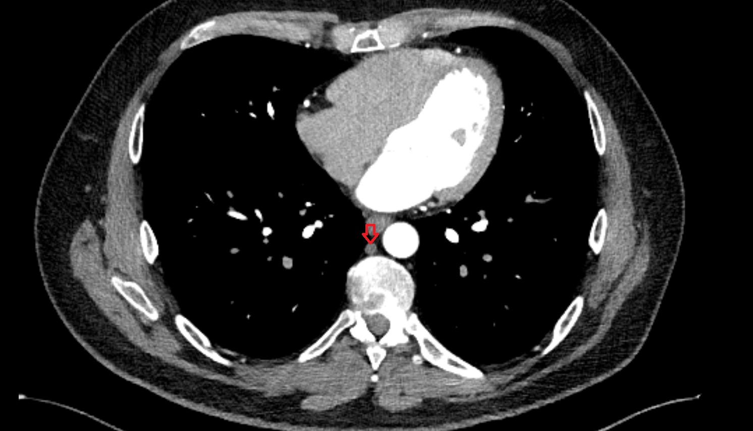 Azygos vein  ct  axial image -img-00000-00000_00001