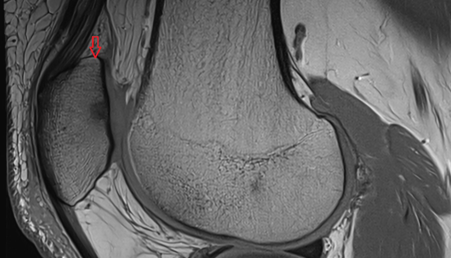 Base of Patella  sagittal cross sectional anatomy 3T MRI AI enhanced  radiology  anatomy image-img-00000-00000