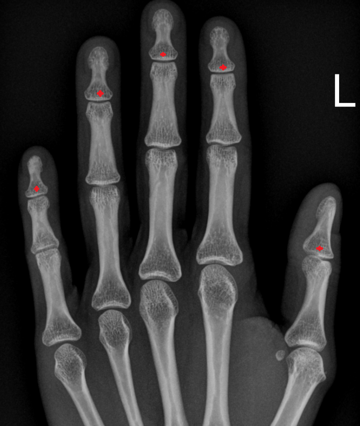 Base of distal phalanx