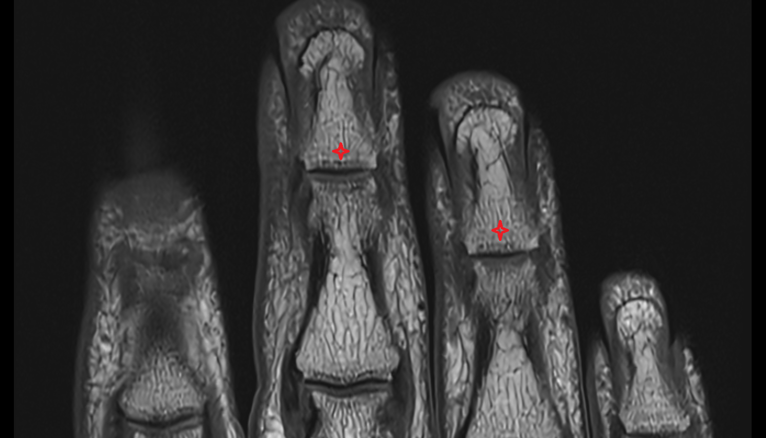 Base of distal phalanx  MRI CORONAL image-img-00000-00000