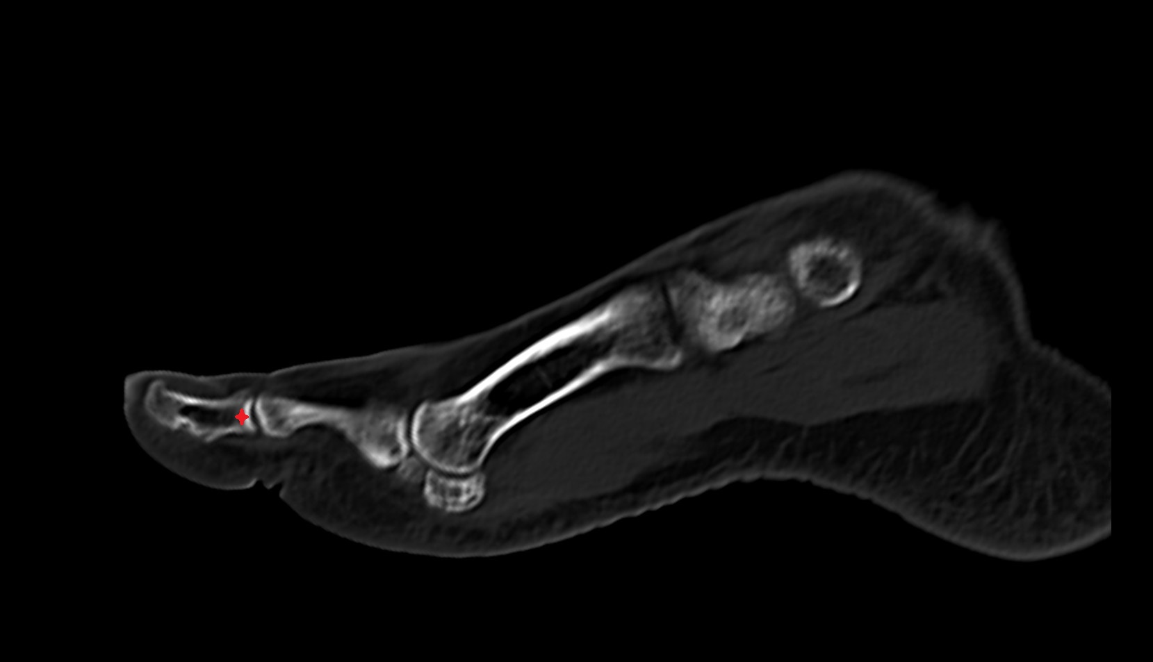Base of distal phalanx of great toe ct