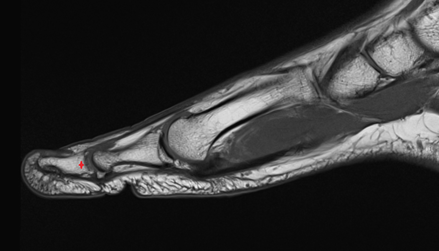 Base of distal phalanx of great toe mri  anatomy labelled image-img-00000-00000