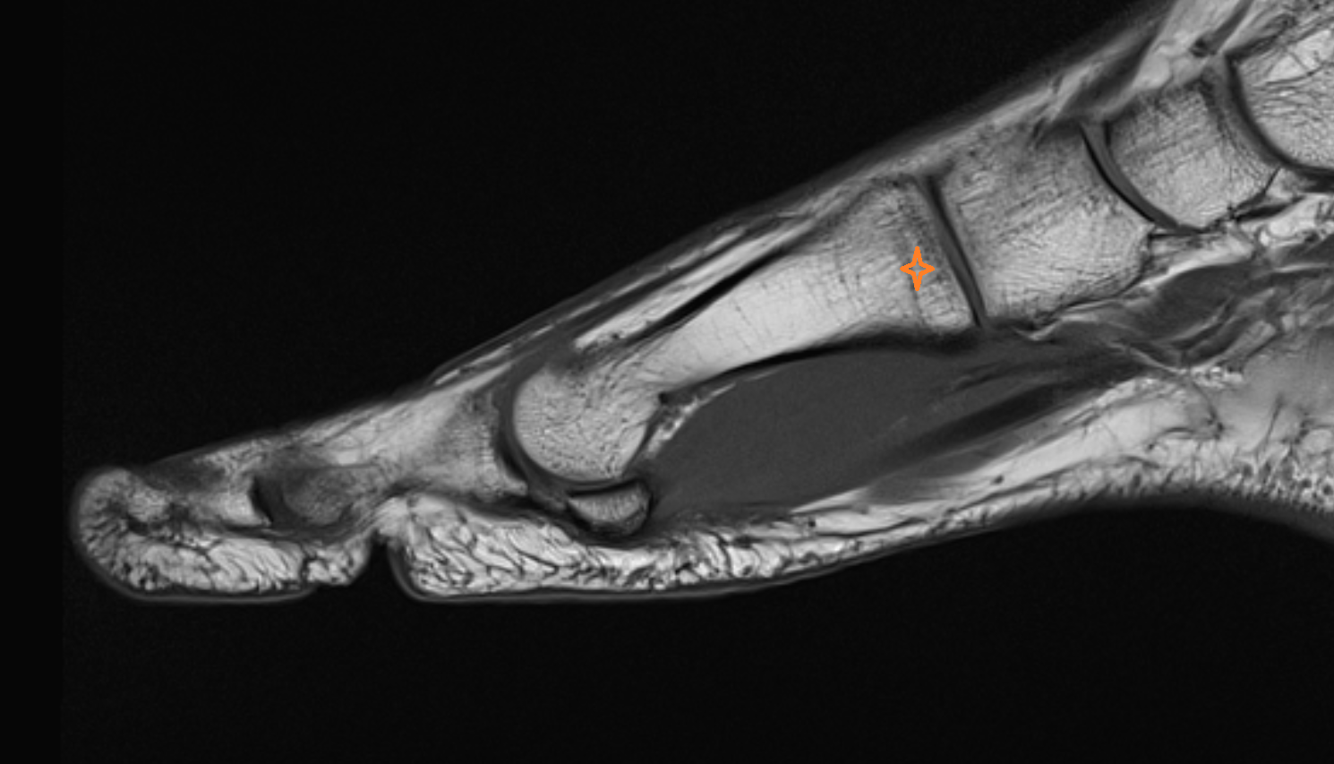Base of first metatarsal bone mri  anatomy labelled image-img-00000-00000