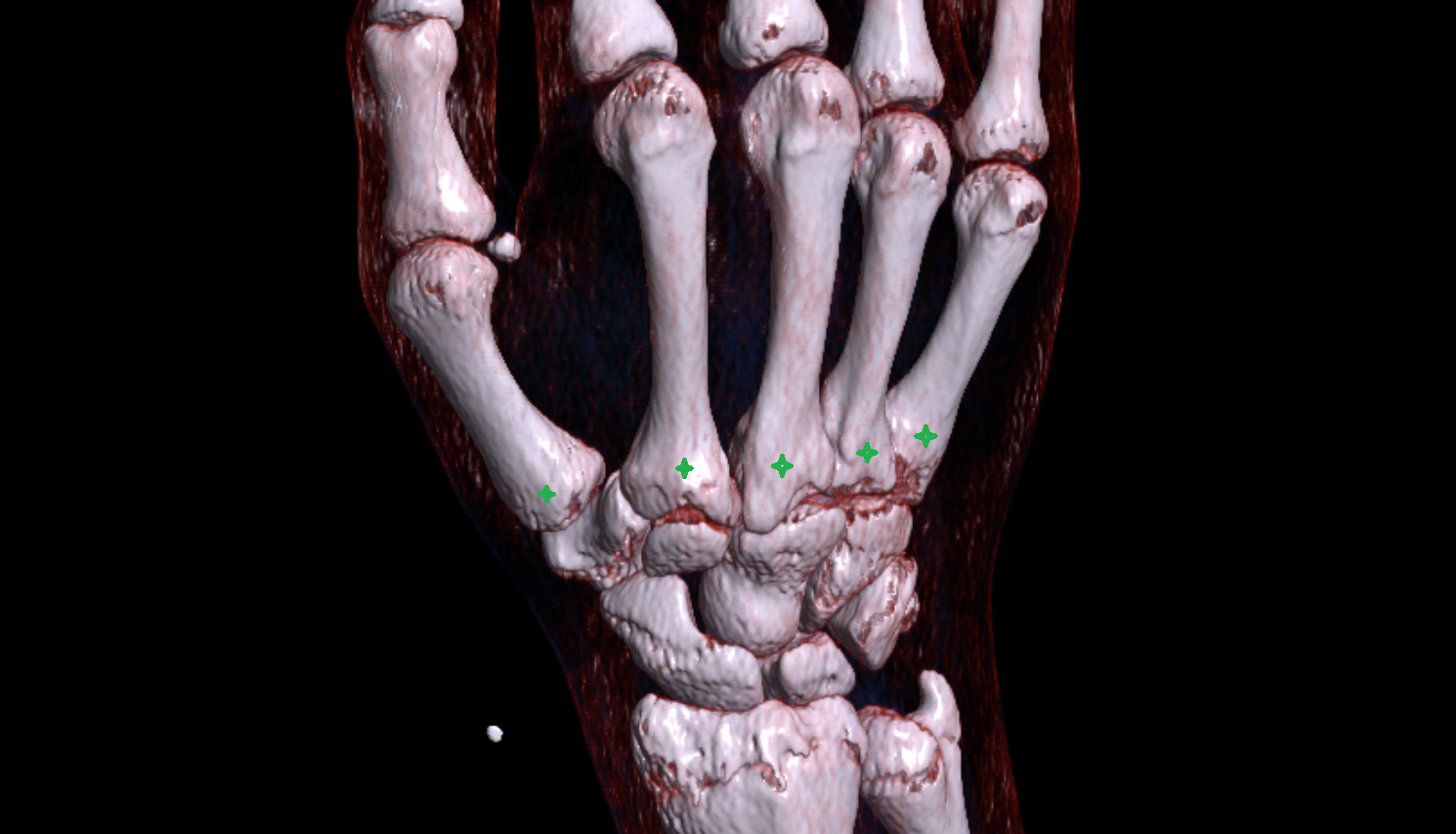 Base of metacarpal bone CT 3D VRT image -img-00000-00000