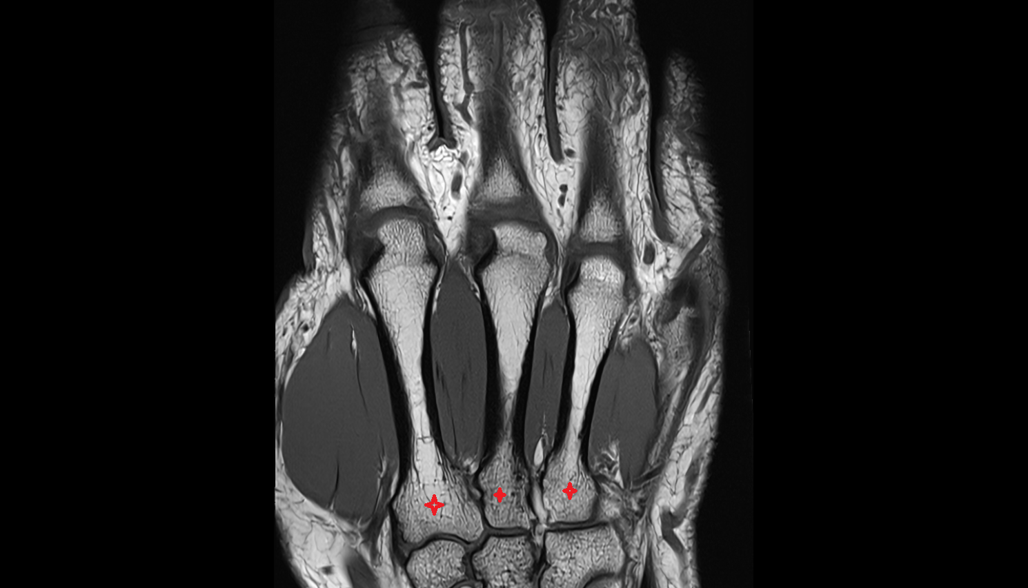 Base of metacarpal bone coronal cross sectional anatomy 3T MRI AI enhanced radiology image-img-00000-00000