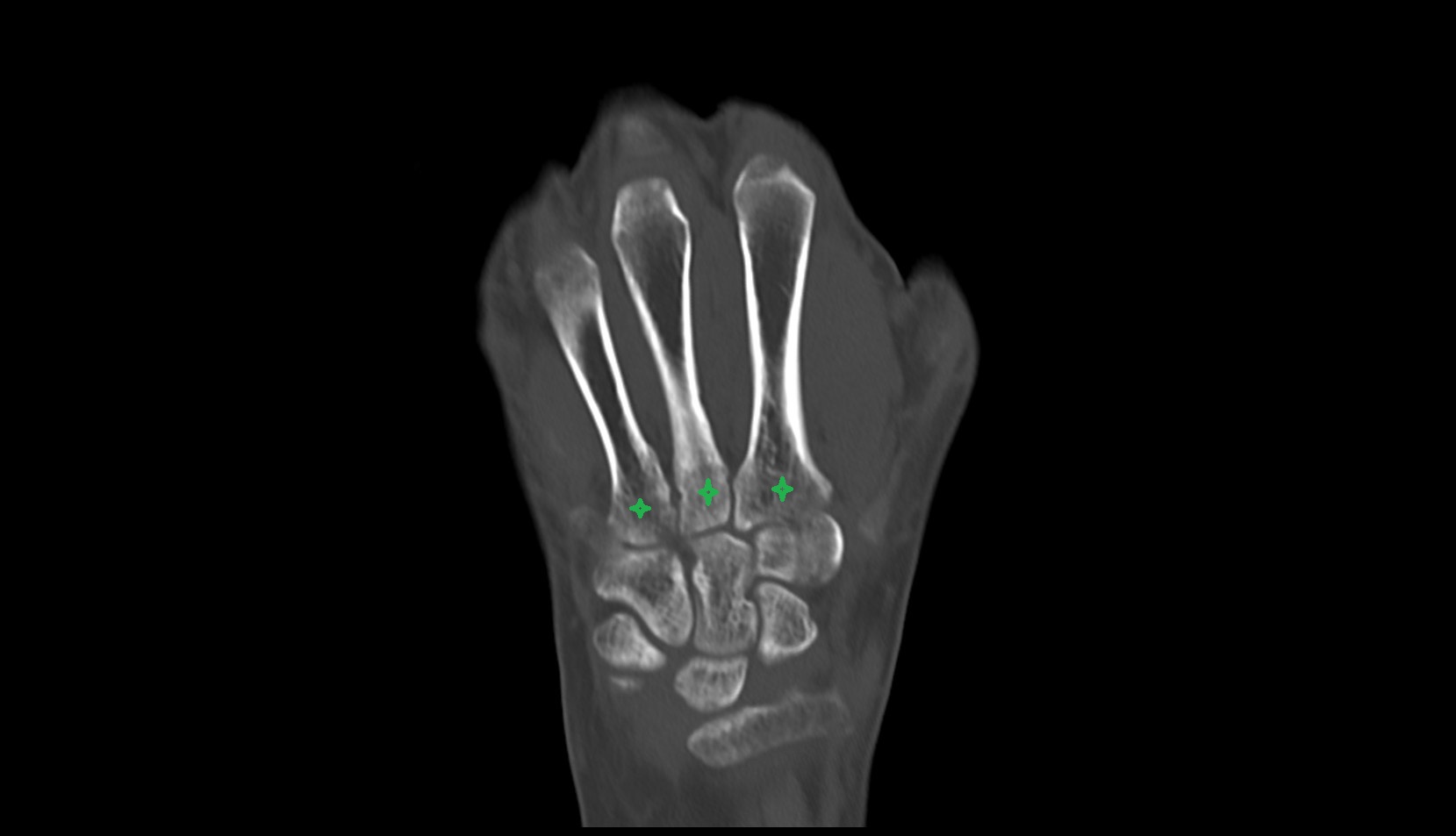 Base of metacarpal bone  ct image