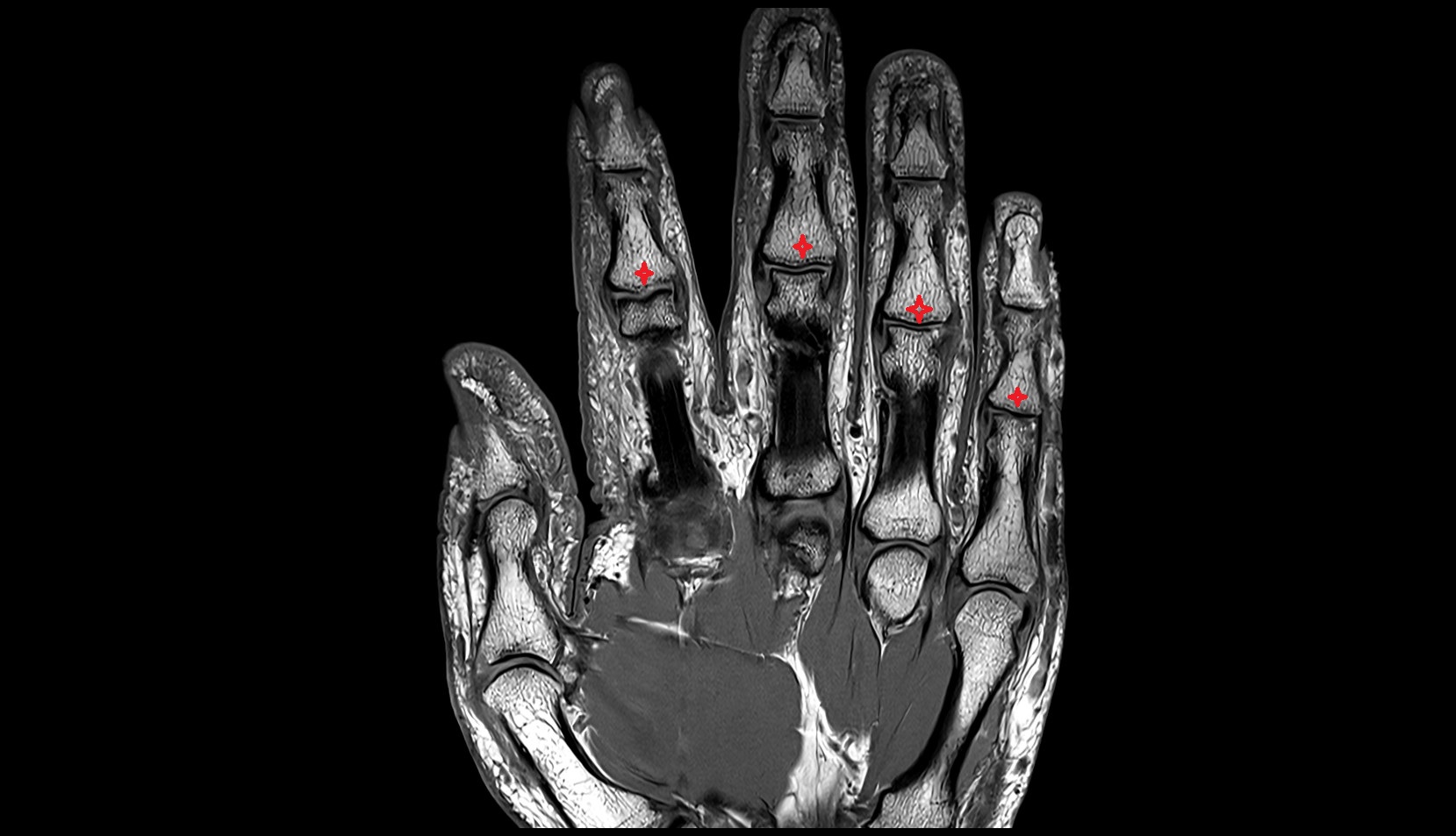 Base of middle phalanx mri image