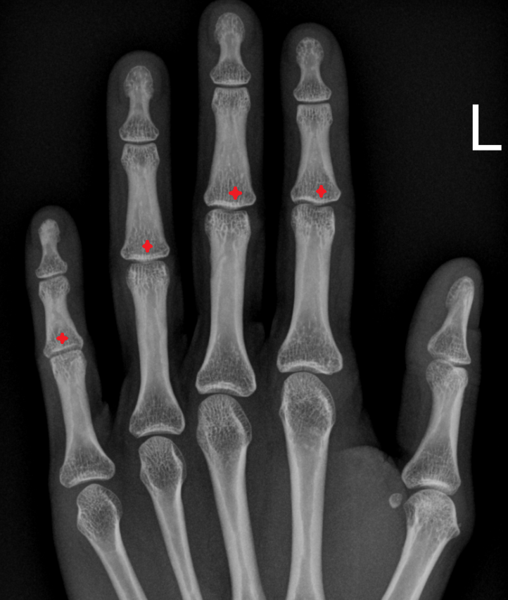 Base of middle phalanx x ray