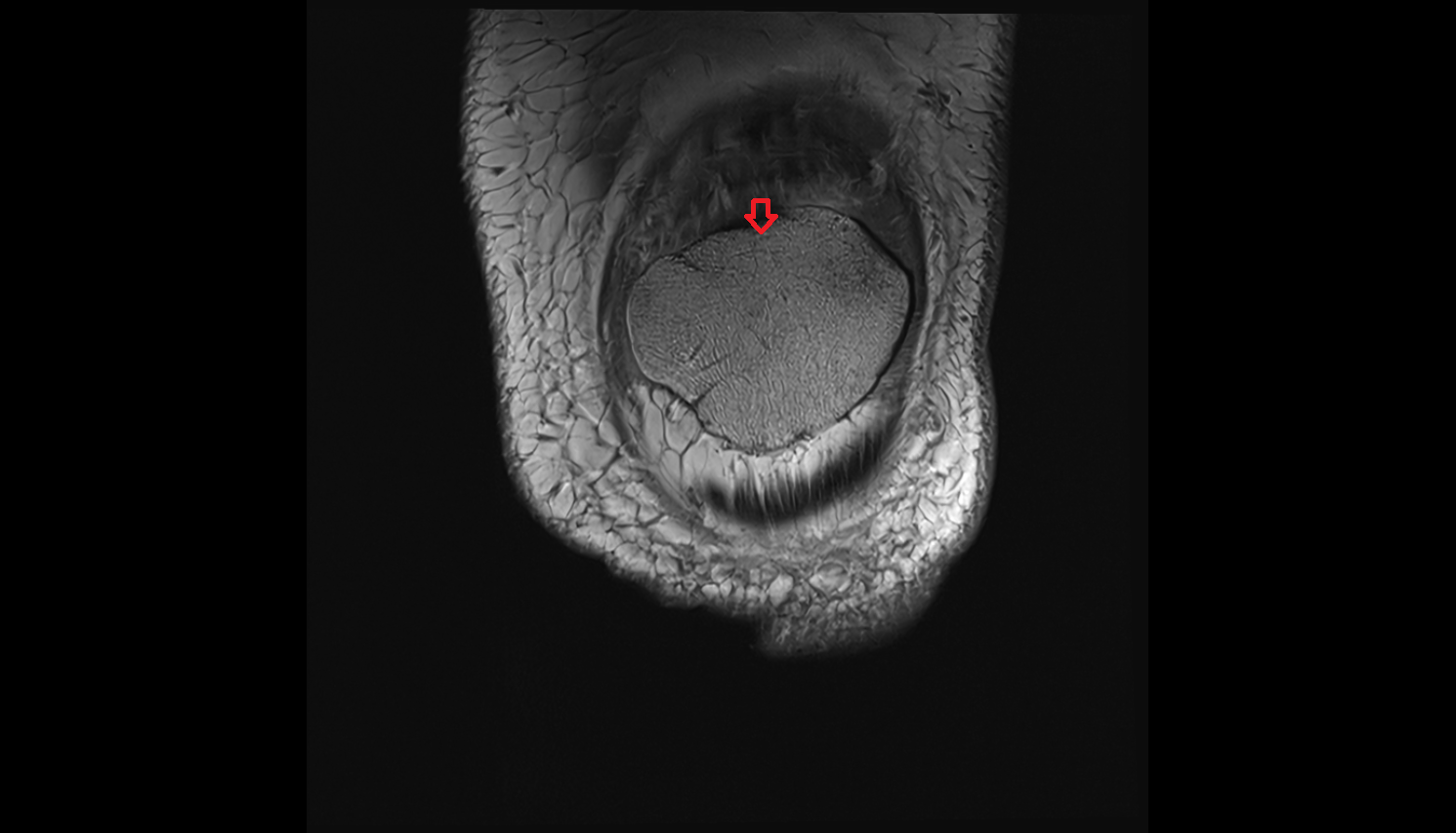 Base of patella coronal cross sectional anatomy 3T MRI AI enhanced  radiology  anatomy image-img-00000-00000