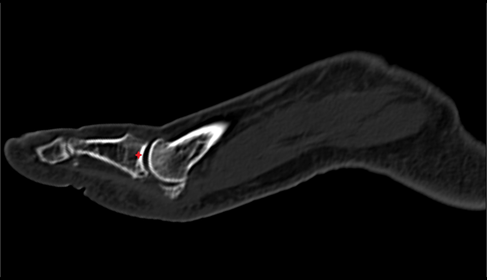 Base of phalanx ct sag image