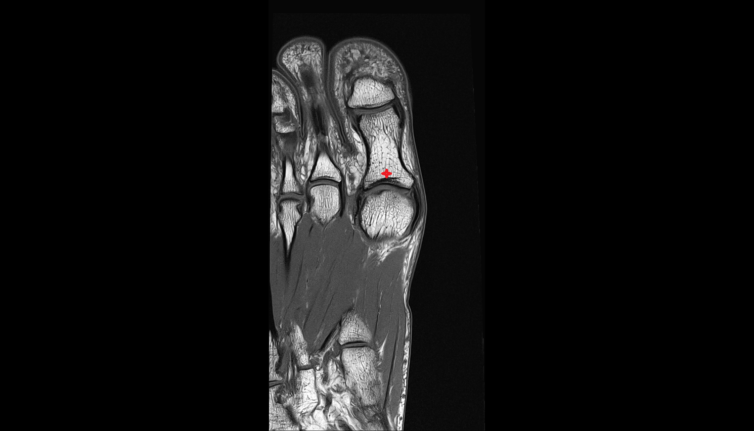 Base of phalanx of foot coronal cross sectional anatomy 3T MRI AI enhanced radiology image-img-00000-00000