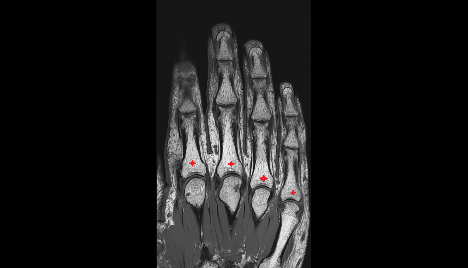 Base of proximal phalanx  MRI CORONAL image-img-00000-00000
