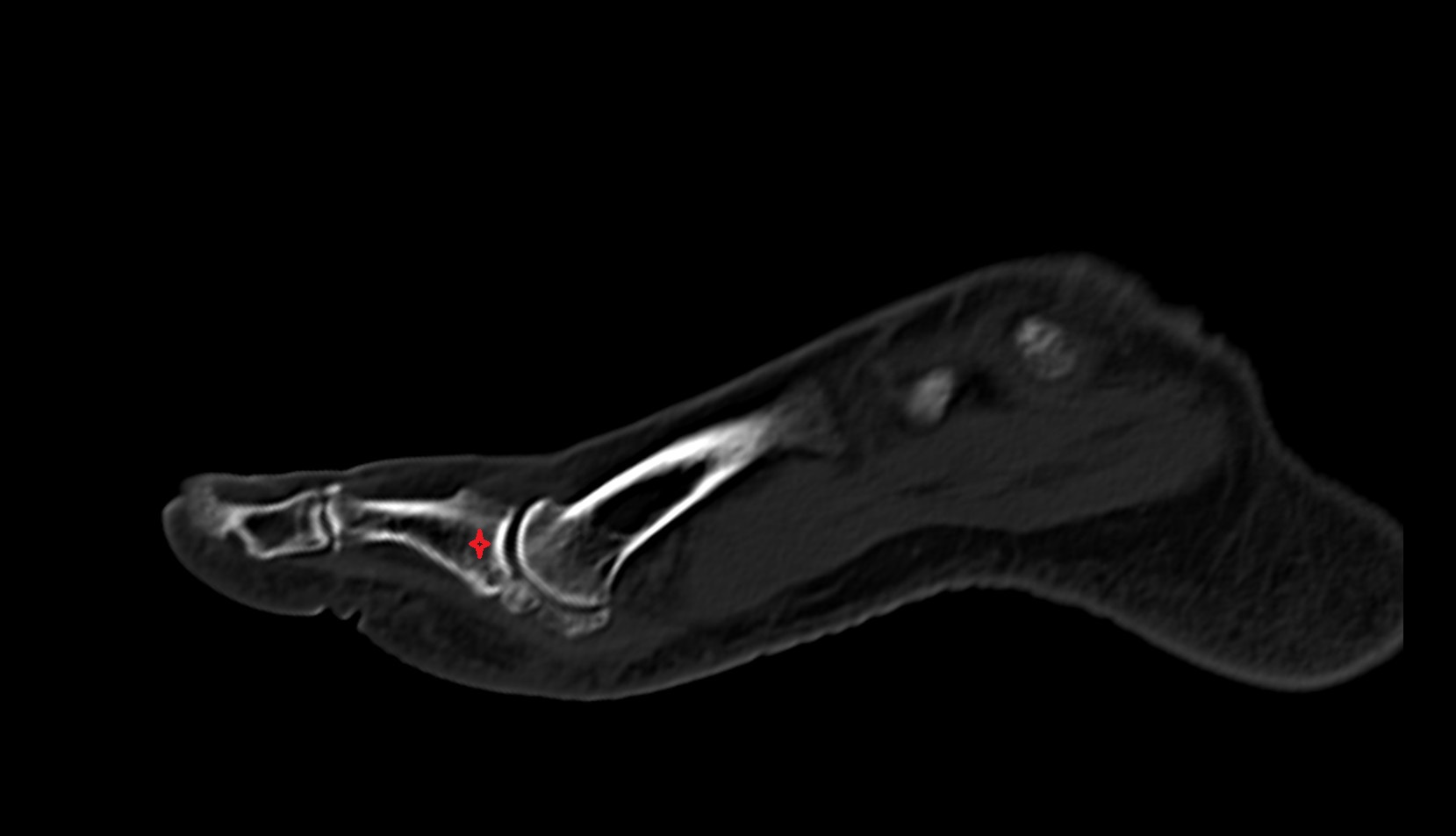 Base of proximal phalanx of great toe ct