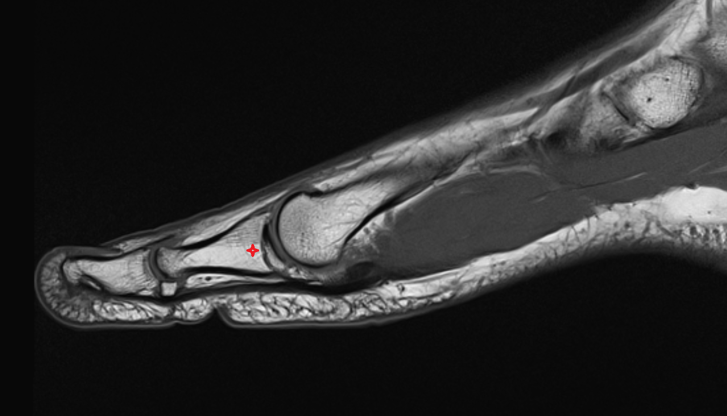 Base of proximal phalanx of great toe mri  anatomy labelled image-img-00000-00000