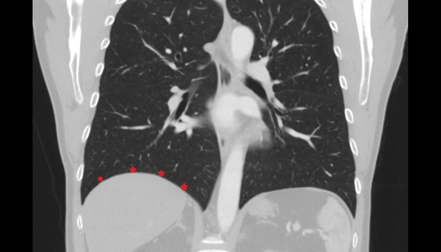 Base of right lung CT anatomy image -img-00000-00000