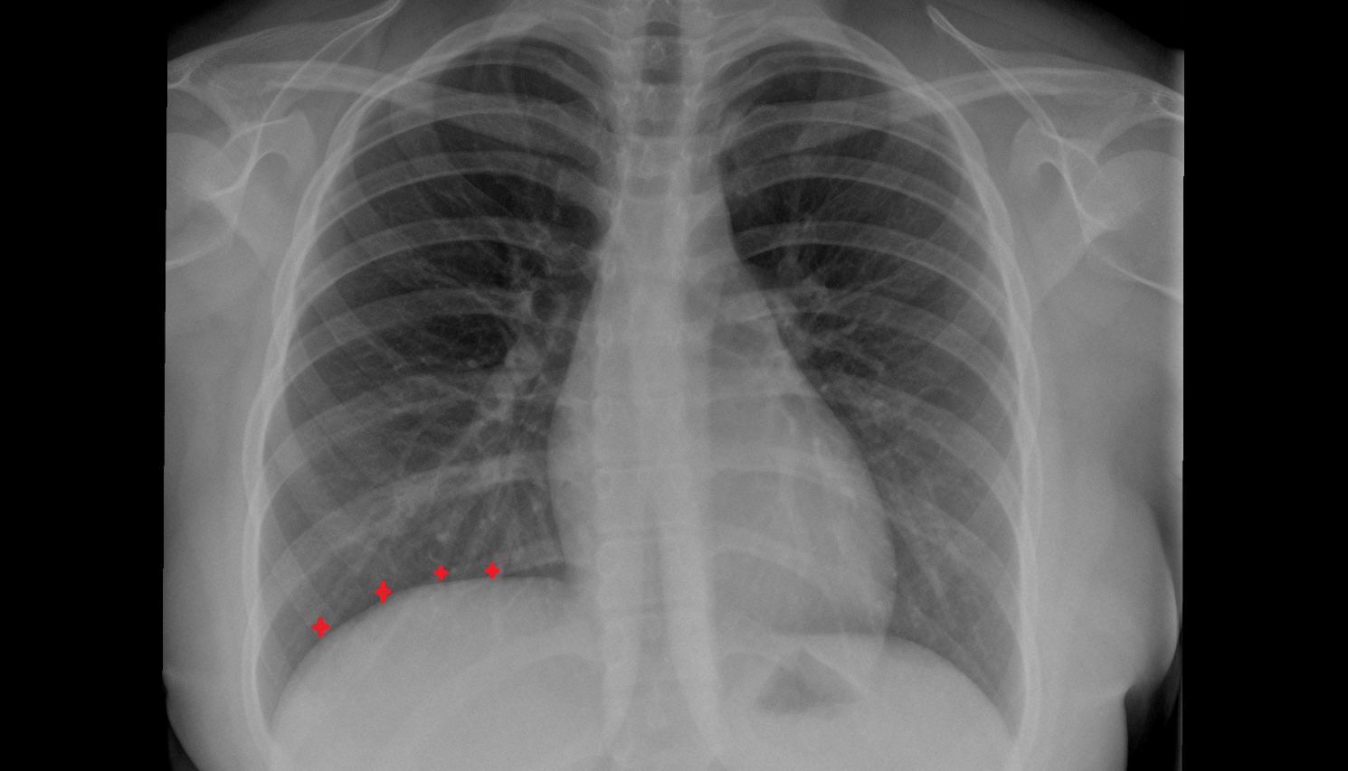 Base of right lung X RAY anatomy image -img-00000-00000