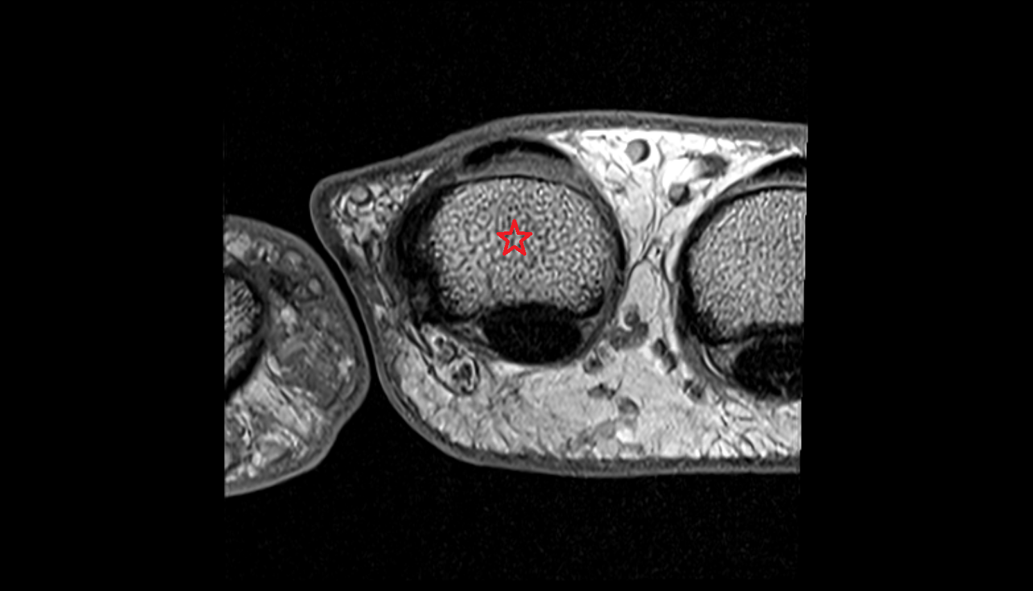 Base of the Phalanx of the Hand axial cross sectional anatomy 3T MRI AI enhanced radiology image-img-00000-00000