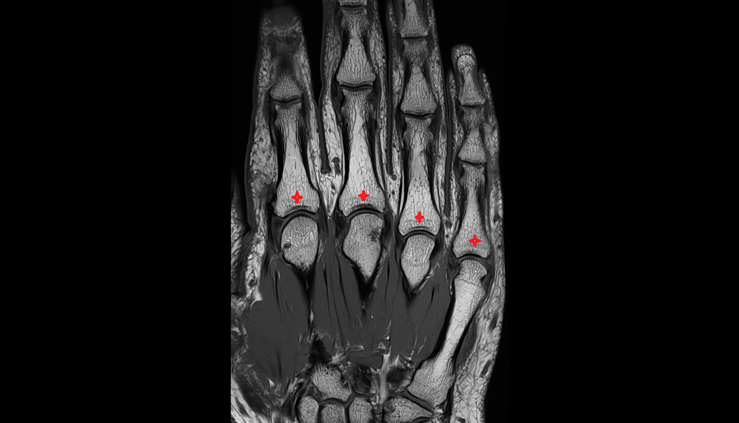 Base of the Phalanx of the Hand coronal cross sectional anatomy 3T MRI AI enhanced radiology image-img-00000-00000