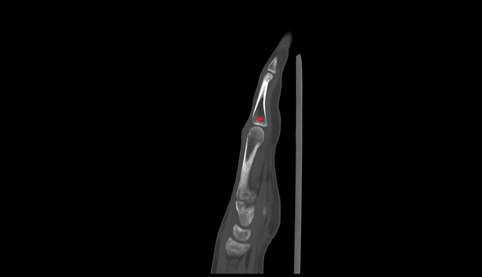 Base of the Phalanx of the Hand ct sag image