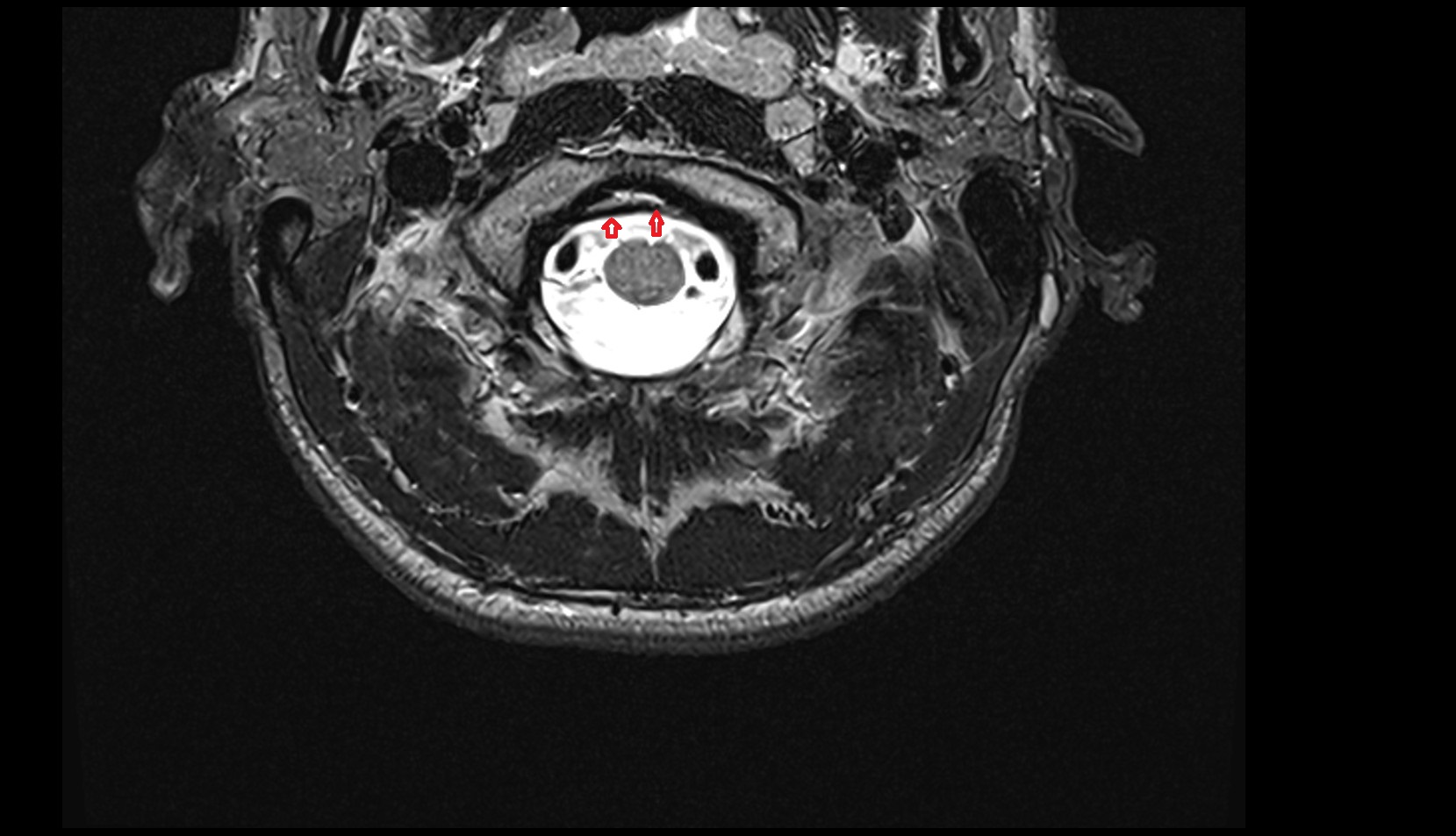 Basilar plexus MRI 3T AXIAL IMAGE