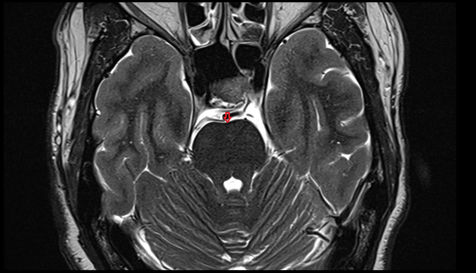 Basilar sulcus MRI 3T axial image